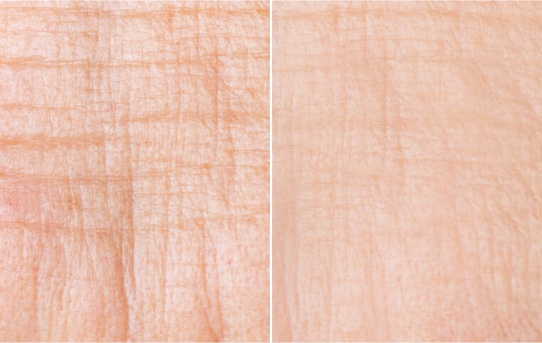 Vor der Behandlung... und nach 30 Nächten.